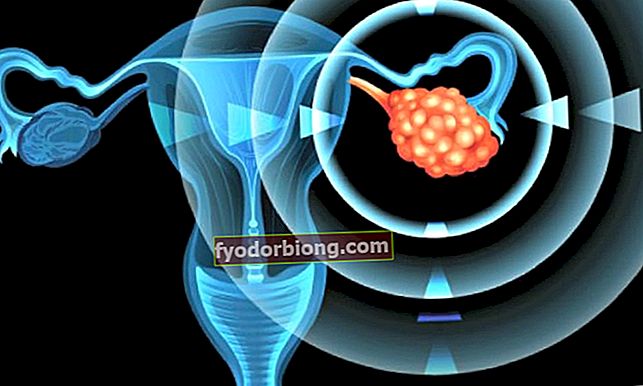 Videnskaben opdager årsag til polycystisk ovarie, og helbredelse kan være på vej