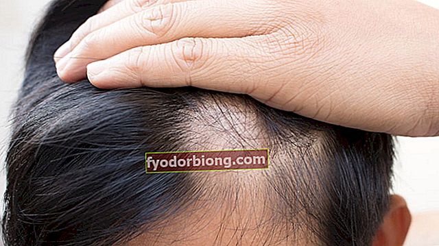 Alopecia areata - Hvad det er, årsager, symptomer og behandling