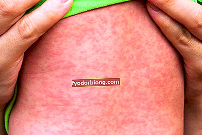 Červená skvrna na pokožce - 10 nemocí, které mohou poškodit vaše tělo